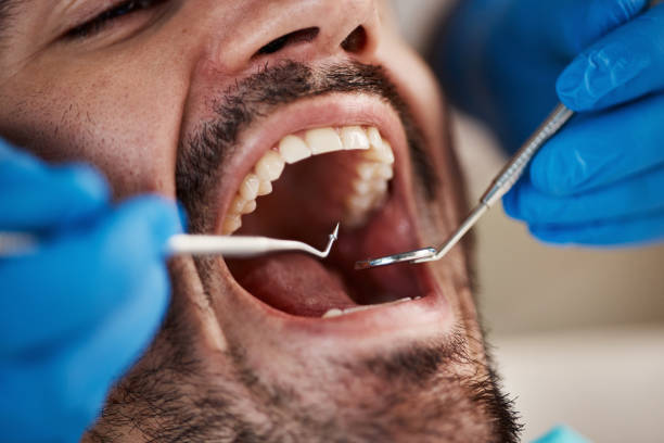 Best Emergency Wisdom Teeth Removal in Kingstowne, VA