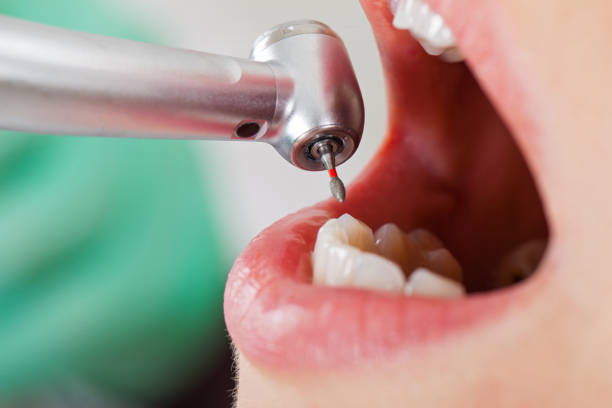 Best Emergency Tooth Extraction in Kingstowne, VA